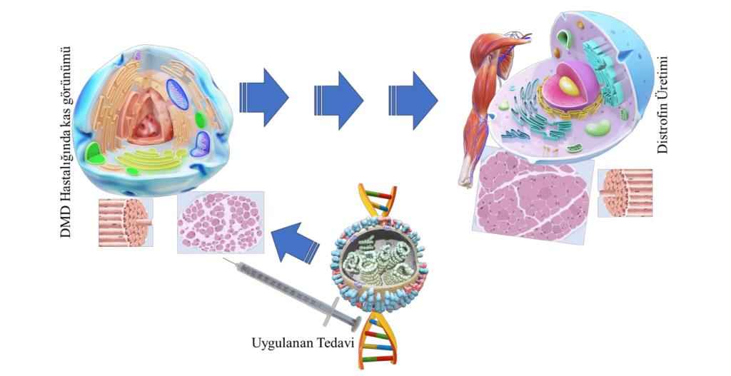Tıp Fakültemizden DMD Hastaları için Umut Verici Çalışma